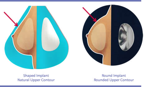 Can You Tell Round from Shaped Breast Implants? - Northwest Center for  Aesthetic Plastic Surgery